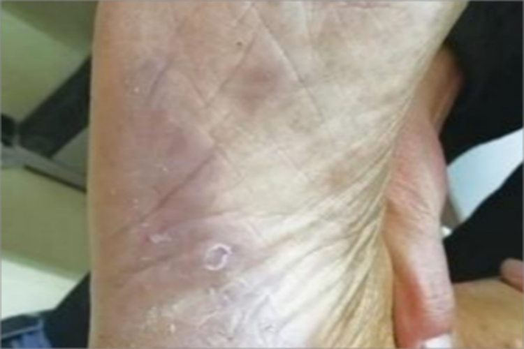 持久性隆起性红斑脚底症状图