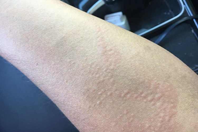 慢性湿疹胳膊小红疙瘩图