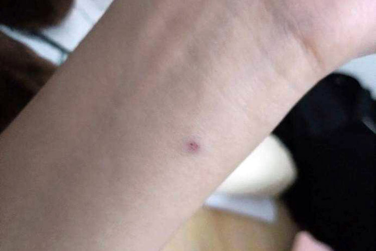 结核皮试48小时正常图 结核皮试48小时正常图