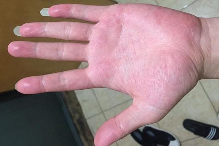 血热证手掌图