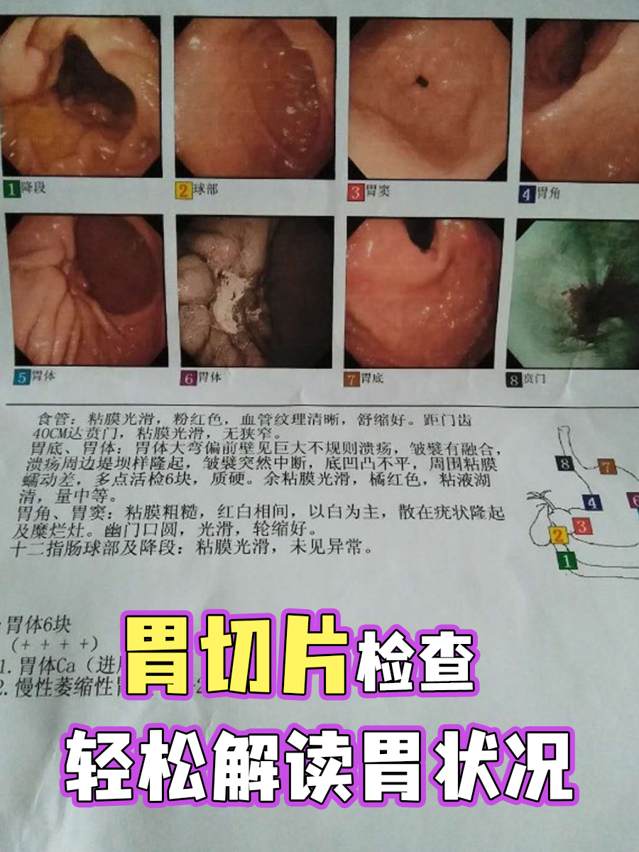 胃切片检查，轻松解读胃状况