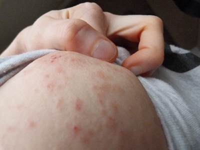 色素性痒疹的症状和图片 
