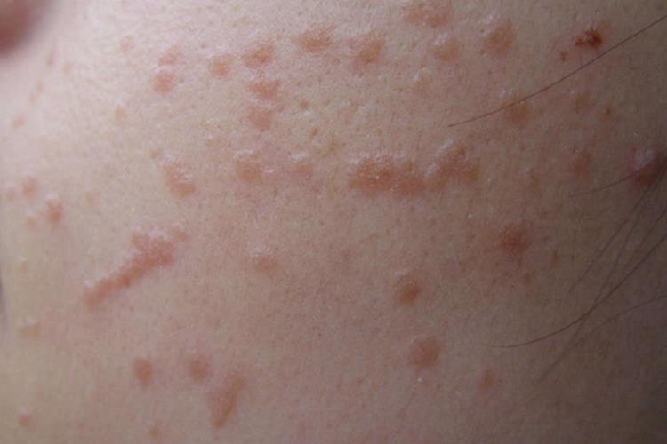 HPV扁平疣图 HPV扁平疣图