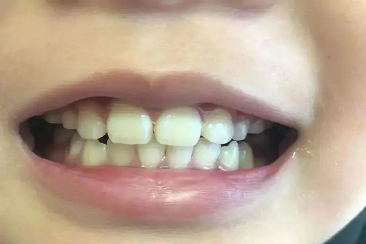 牙齿咬合不正不对缝图