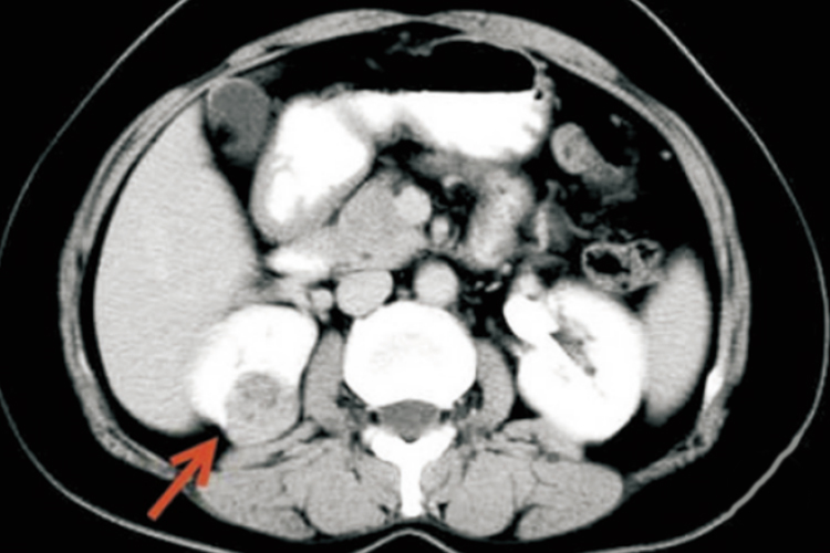 良性肾肿瘤图