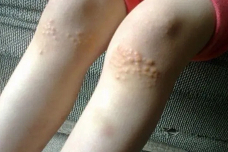 多发性皮脂腺囊肿小腿症状图