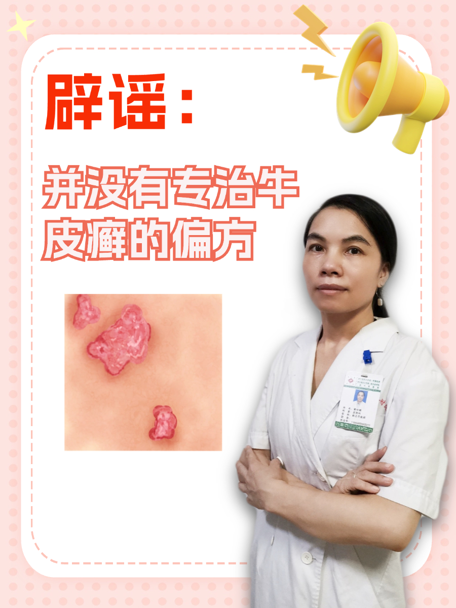 辟谣：并没有专治牛皮癣的偏方