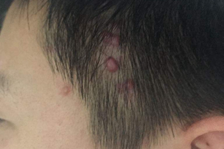 网状组织细胞肉芽肿头皮症状图 网状组织细胞肉芽肿头皮症状图