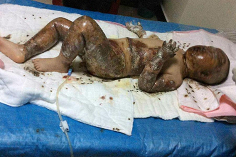 Ⅲ度烧伤全身症状图