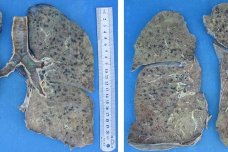 尘肺病肺部黑斑图 尘肺病肺部黑斑图