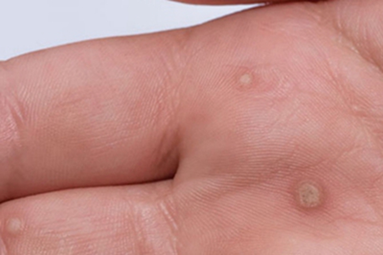 寻常疣手掌粗糙有小疙瘩图