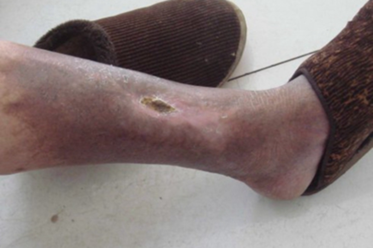 坏疽性臁疮小腿结痂图