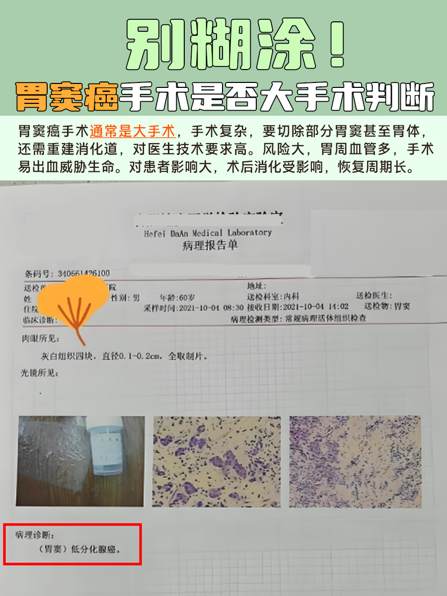 别糊涂！胃窦癌手术是否大手术判断