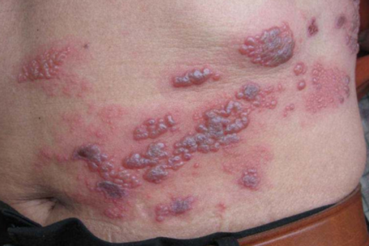 带状疱疹肚子上长水疱图 带状疱疹肚子上长水疱图