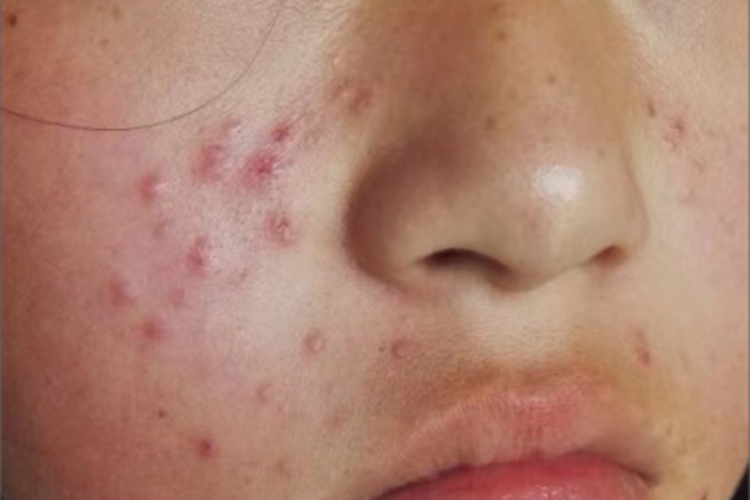 毛囊炎面部症状图