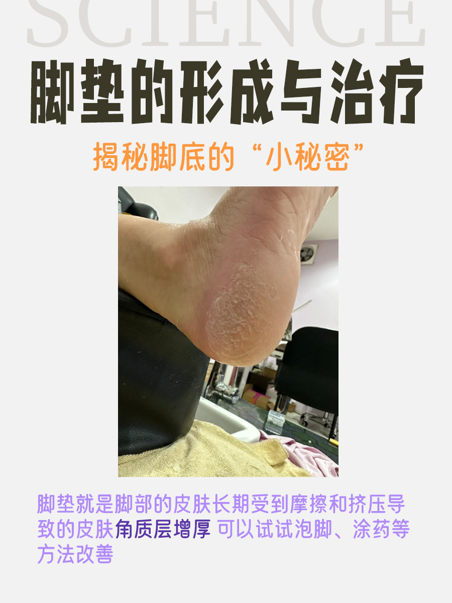 脚垫的形成与治疗｜揭秘脚底的“小秘密”
