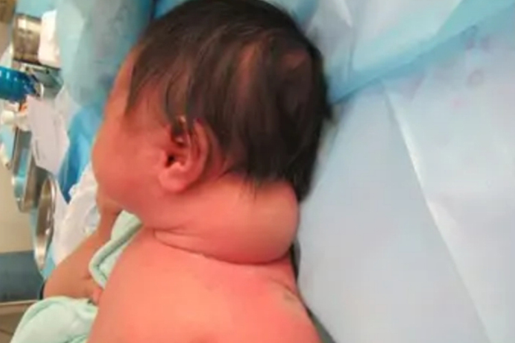 小孩脖子静脉畸形图 小孩脖子静脉畸形图