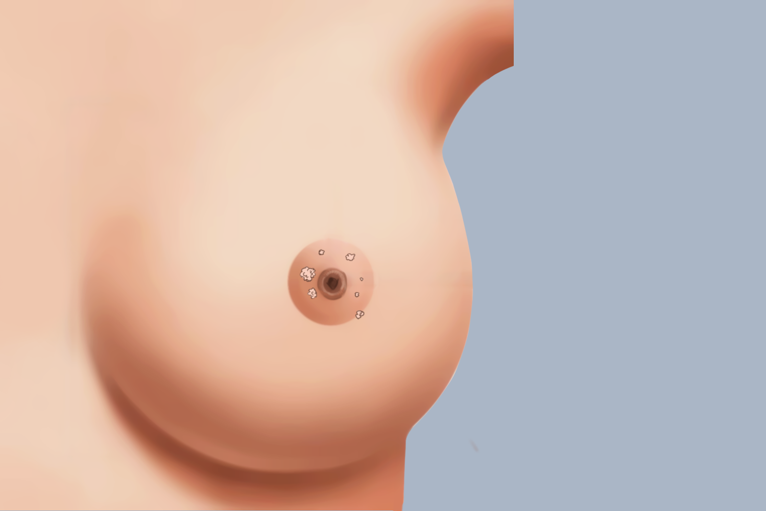 感染HPV乳房上长尖锐湿疣图