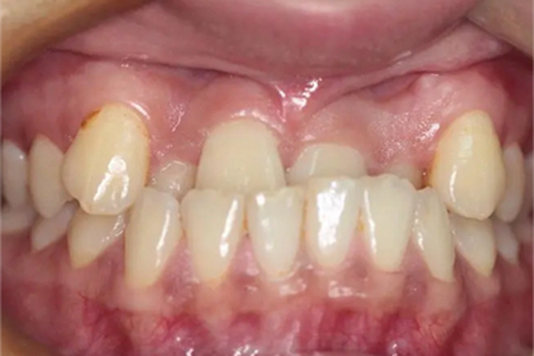 地包天上颌的牙齿向内凹陷图