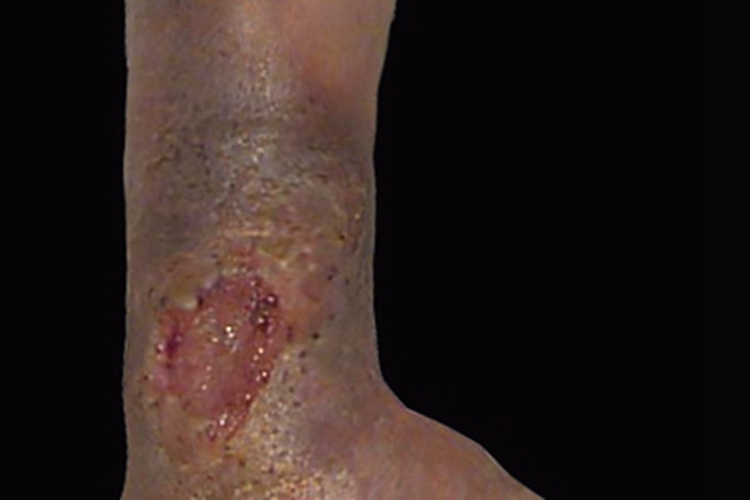 下肢深静脉血栓形成脚踝大坑图