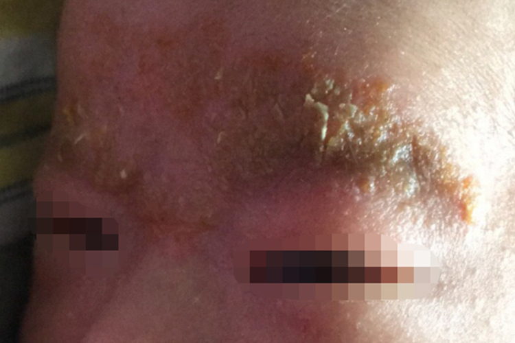 一个月宝宝眉毛上黄痂图