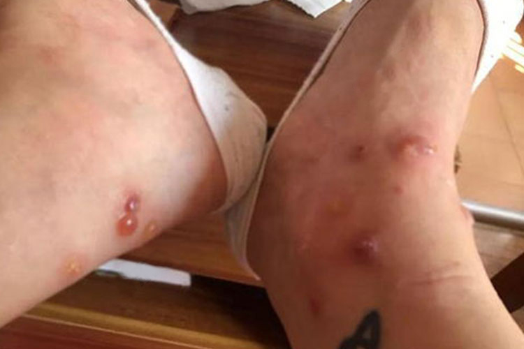 臭虫叮咬后水疱图 臭虫叮咬后水疱图