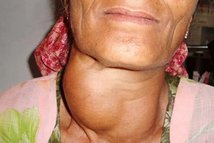 地方性克汀病侧颈大包图