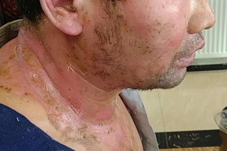 烫伤颈部渗液图 烫伤颈部渗液图