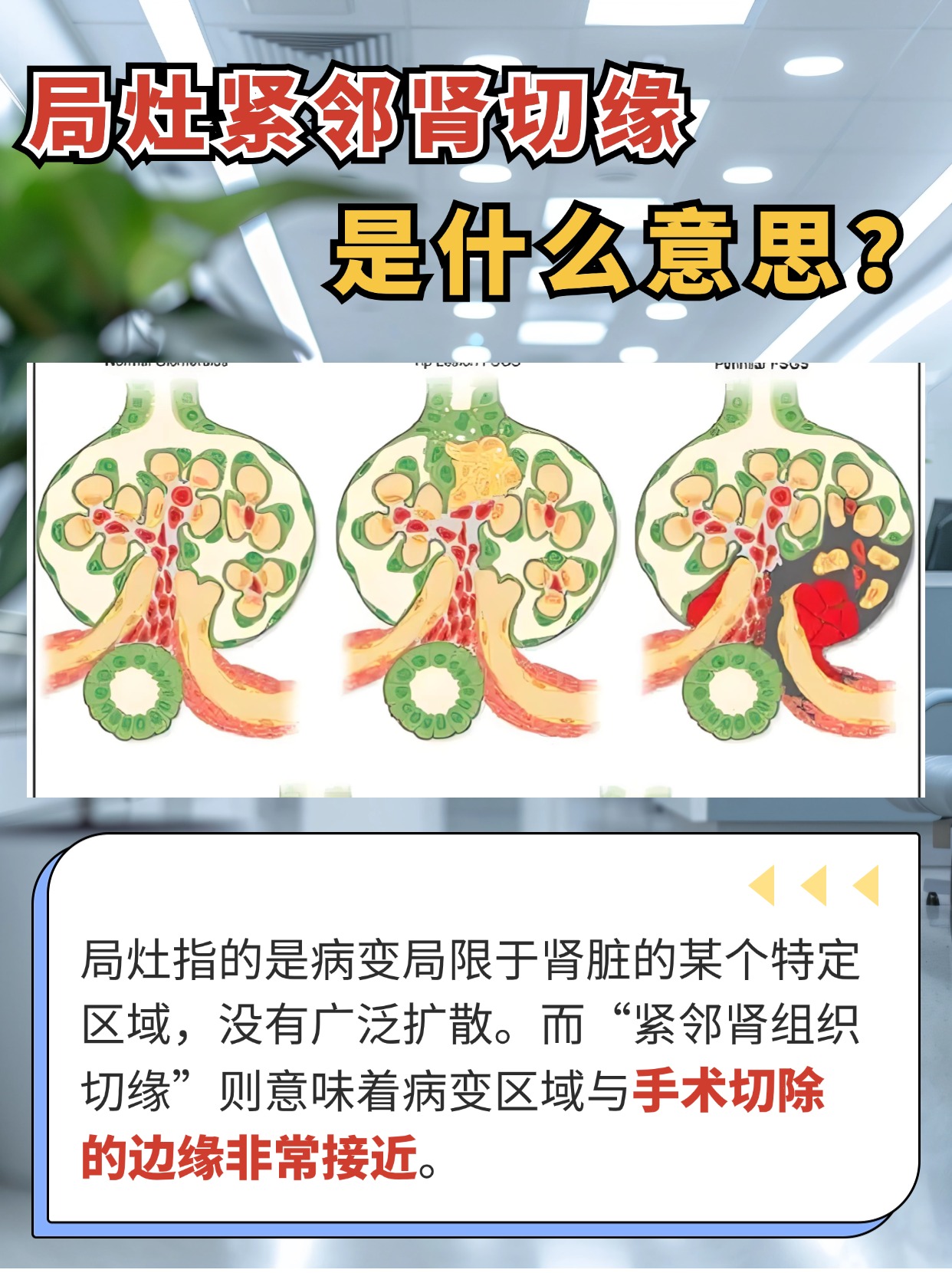 局灶紧邻肾组织切缘：解析与意义