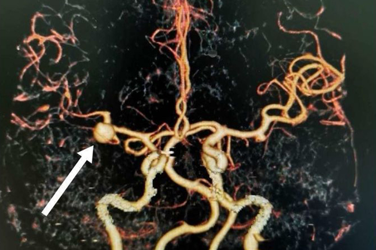 颅内动脉瘤图 颅内动脉瘤图