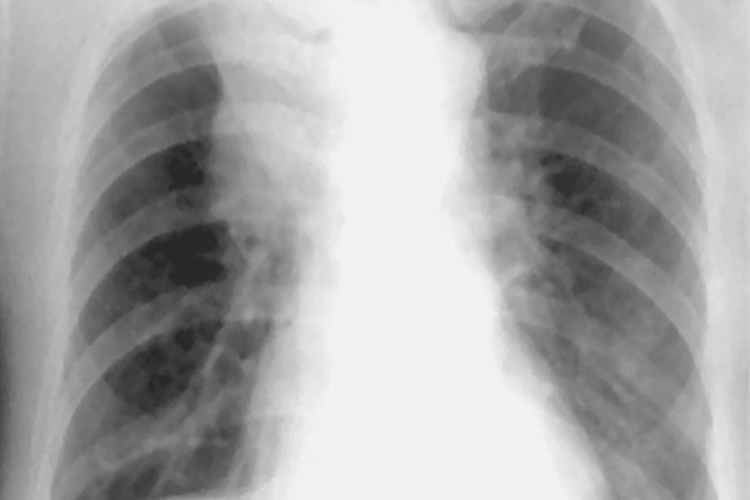 右肺中央型肺癌胸片图