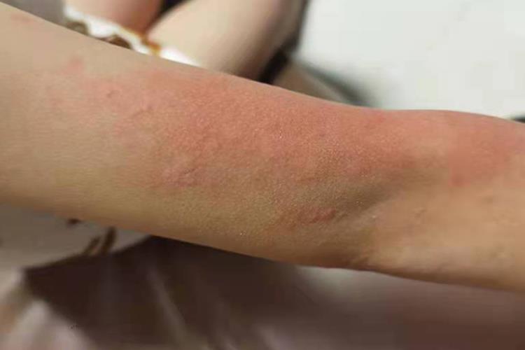 急性自发性荨麻疹风团图