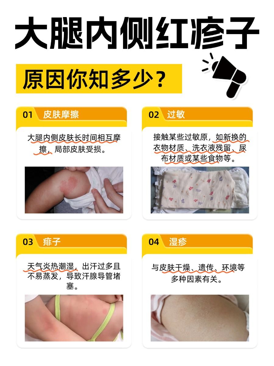 宝妈必看！孩子大腿内侧红疹子，真相在这里！