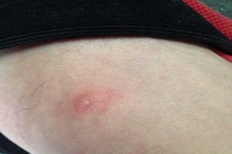 水痘脚背起水疱发红图