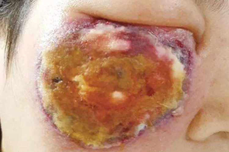 皮肤型毛霉病面部溃疡图 皮肤型毛霉病面部溃疡图