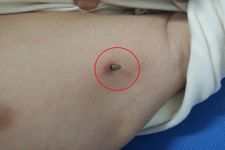 蜱咬伤胸部症状图