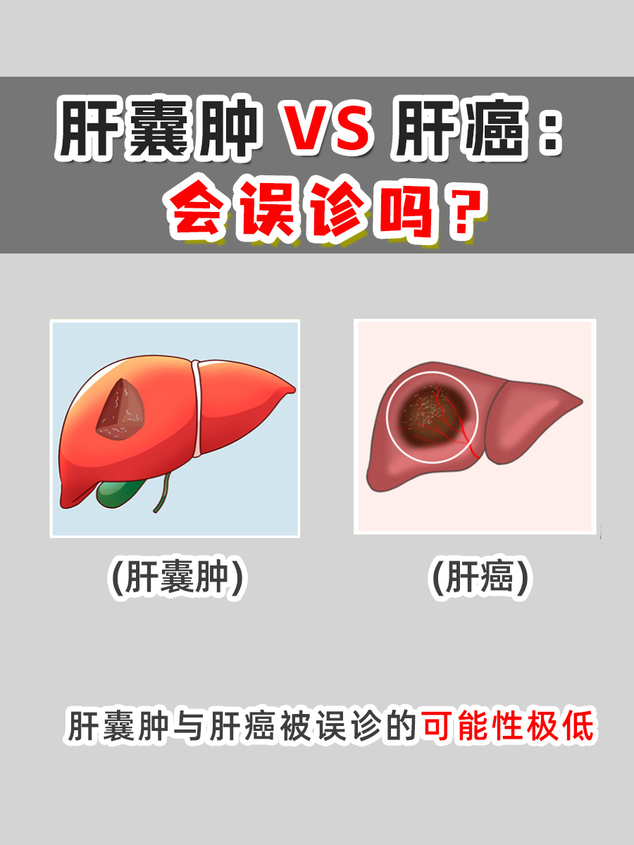 肝囊肿VS肝癌:会误诊吗?
