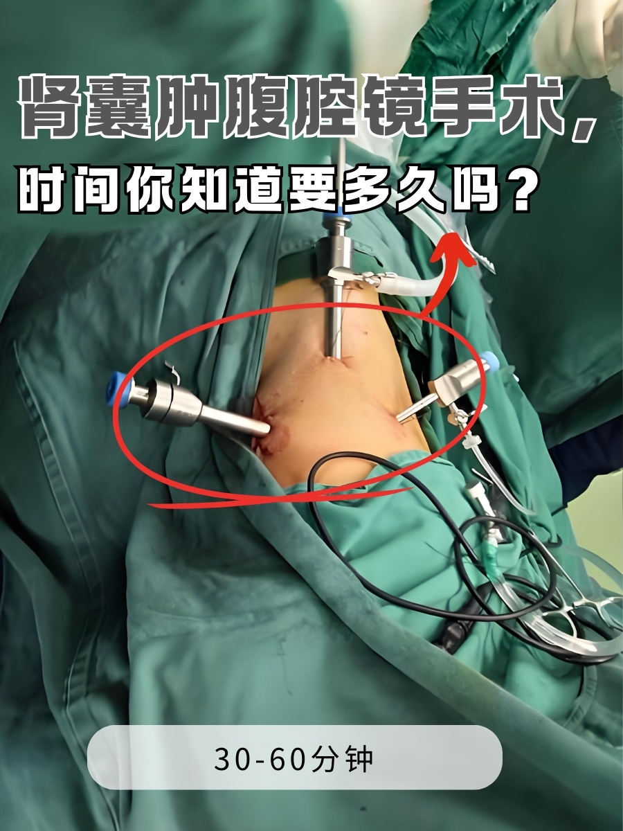 肾囊肿腹腔镜手术，时间你知道要多久吗？