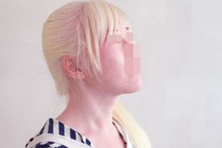 眼皮肤白化病头发浅黄色图