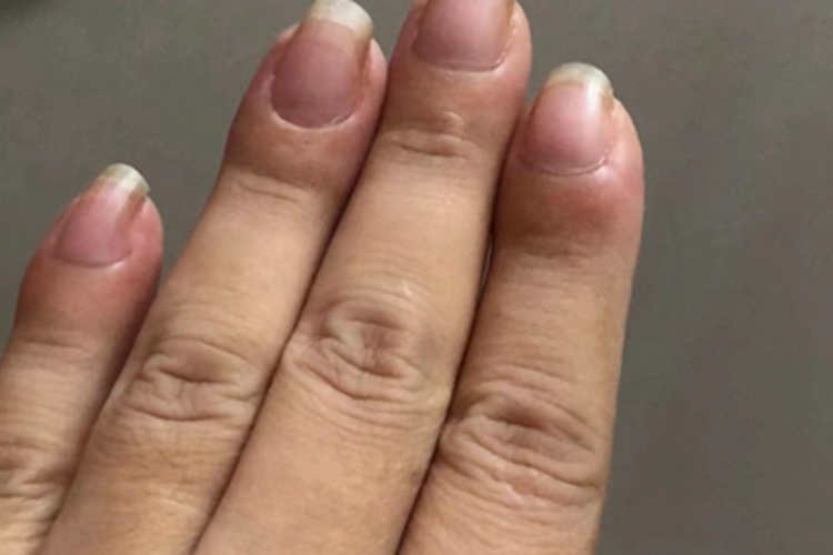 杵状指手指症状图 杵状指手指症状图