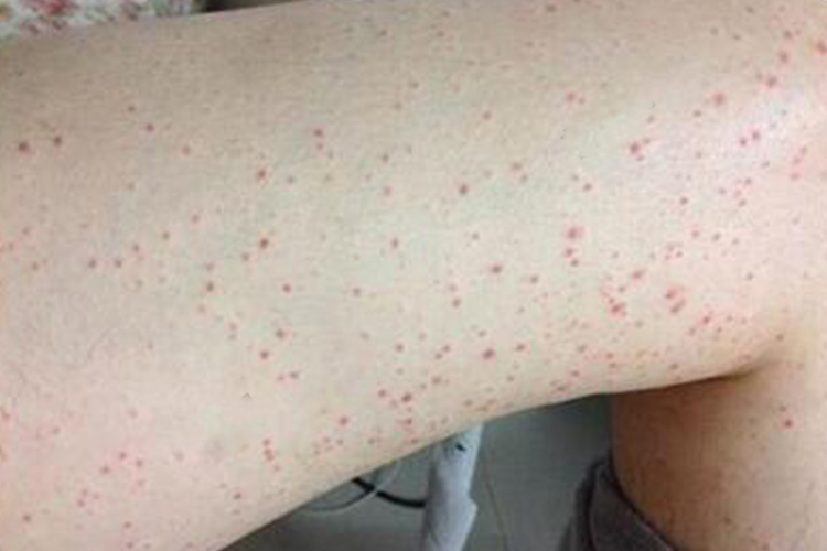 大腿内侧广泛性淤点图