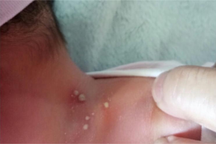 脓疱病后颈脓疱图