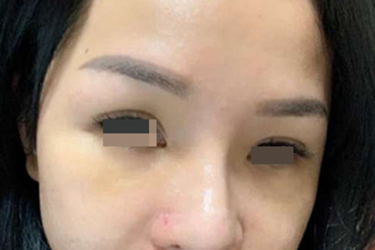 假体隆鼻术后5天开始消肿图