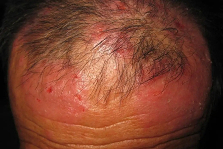 光化性痒疹前额发红图 光化性痒疹前额发红图