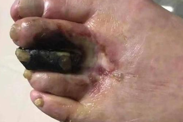 足部干性坏疽图