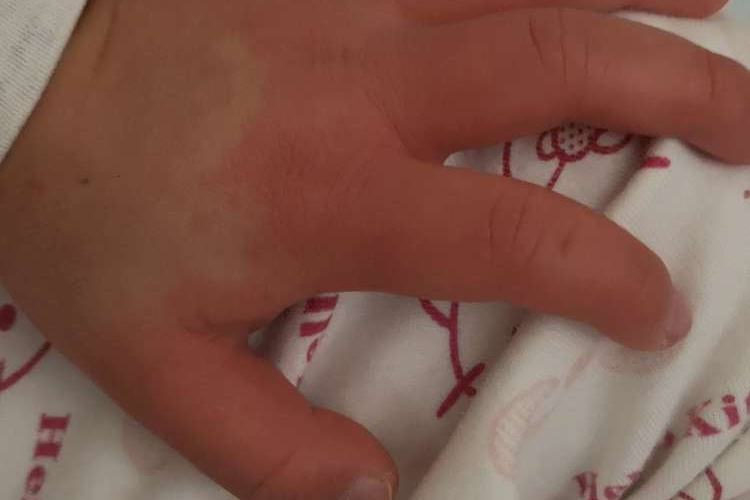 川崎病手硬肿图 川崎病手硬肿图