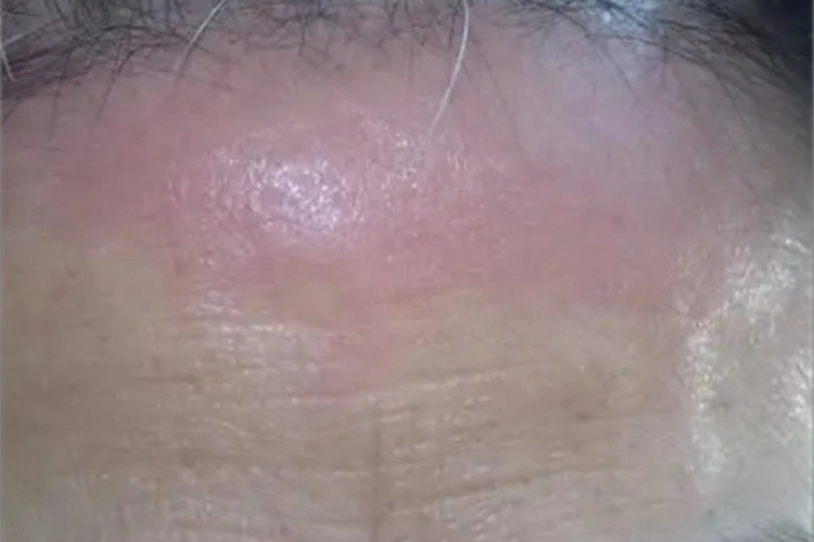 硬红斑前额斑块图