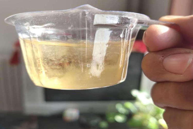 慢性细菌性膀胱炎尿液浑浊图 慢性细菌性膀胱炎尿液浑浊图