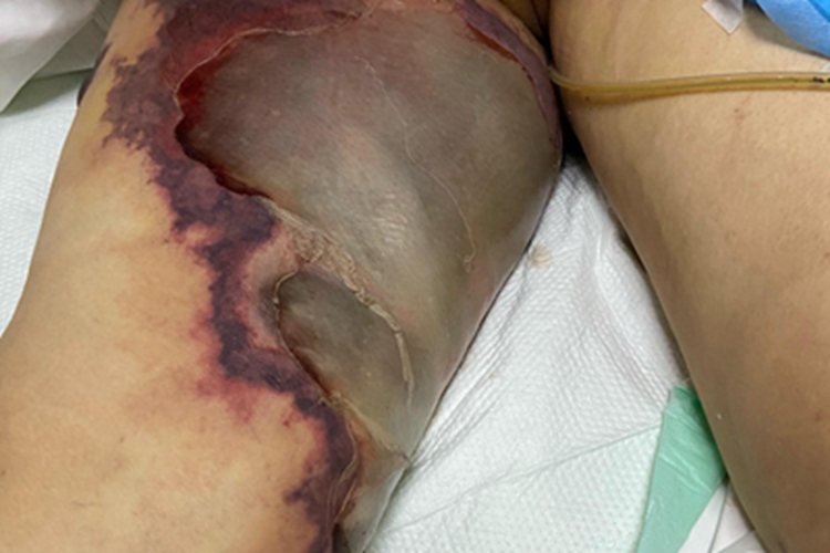 类脂质渐进性坏死皮肤发黑图