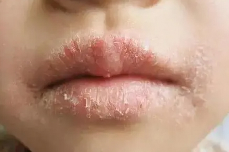 唇炎脱屑症状图